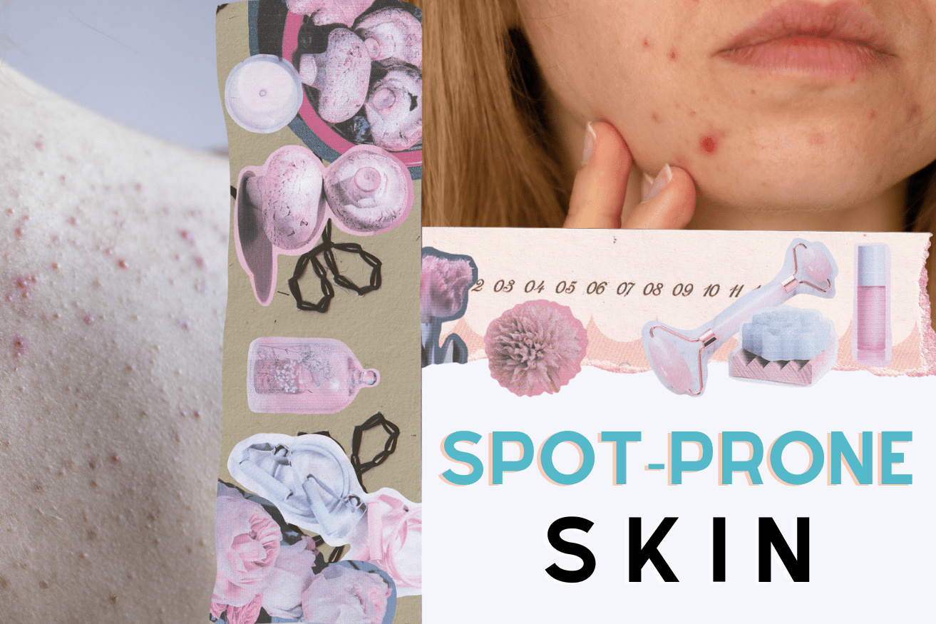 Image: Woman with spot prone skin on her face and back. Text: Spot-prone skin.
