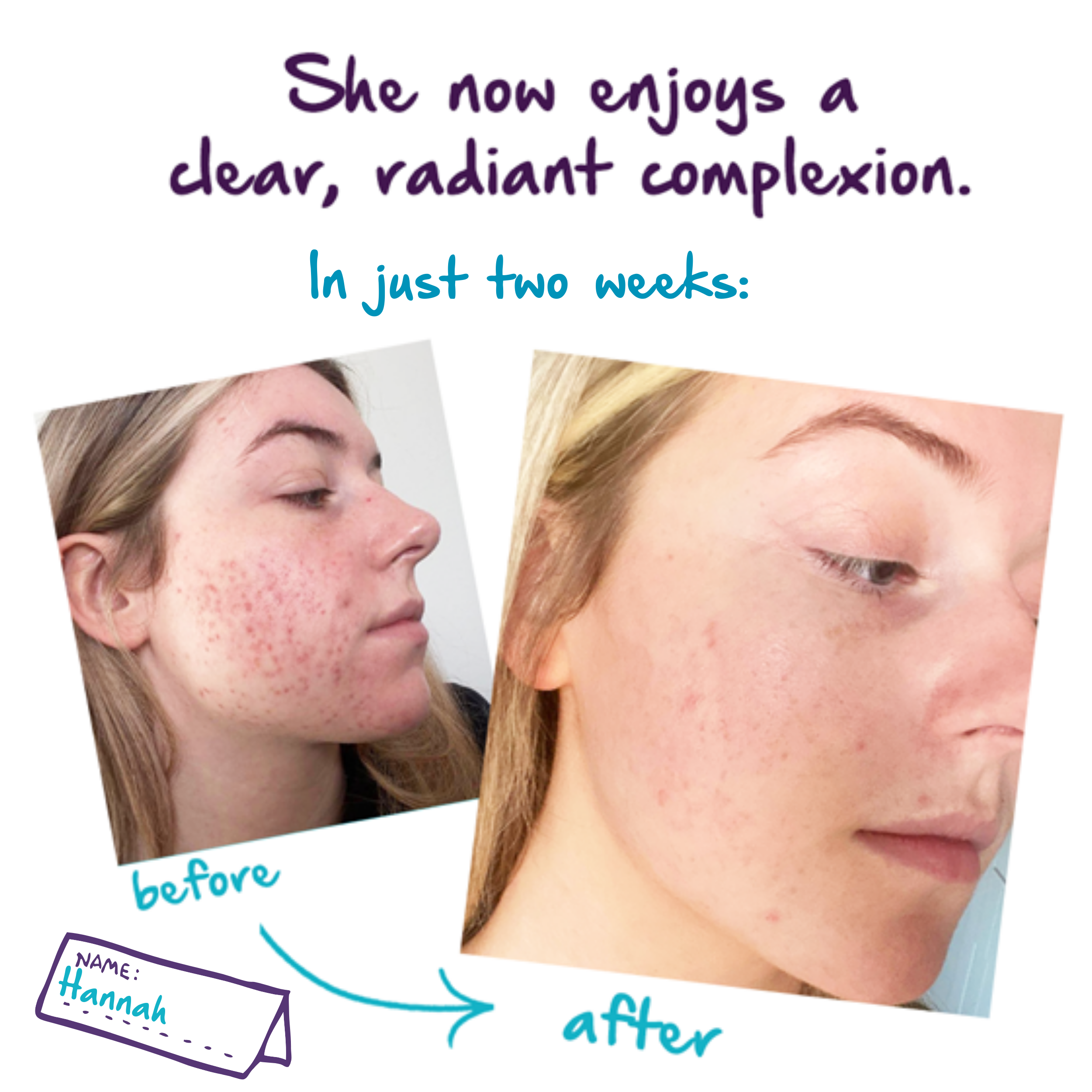 In two weeks hannah saw clearer skin when using the bare addiction range.